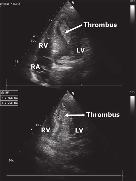 lv thrombus vs demonstrable lv thrombus|Lv thrombus morphology.